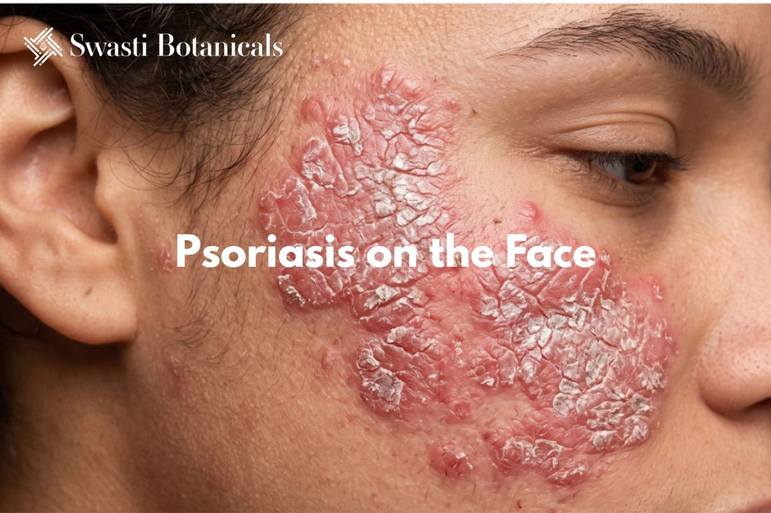 Psoriasis on the Face: What It Looks Like and How to Care for It