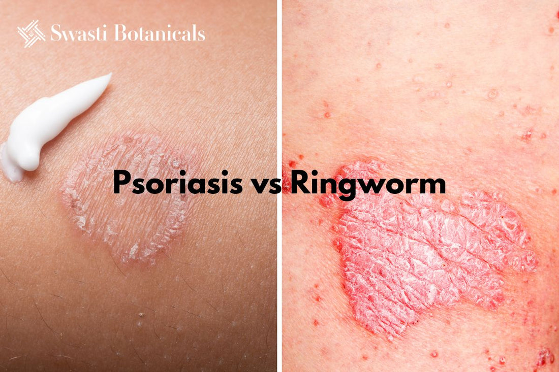 Psoriasis vs Ringworm: How to Tell Them Apart