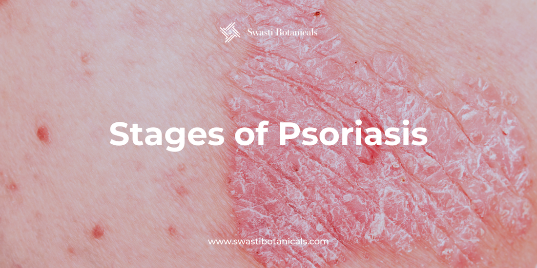 Stages of Psoriasis - From Mild to Severe Explained