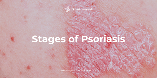 Stages of Psoriasis - From Mild to Severe Explained