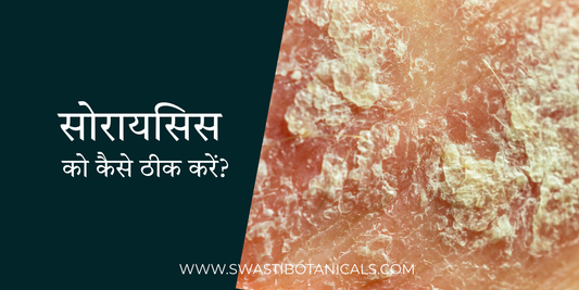 सोरायसिस: लक्षण, कारण, उपचार और घरेलू उपचार